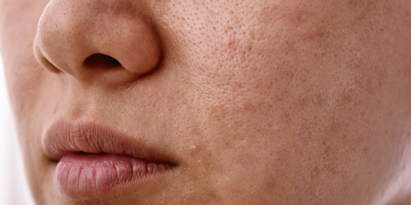 Accutane and Dry Skin: What Is Normal, What Is Not, and How to Cope