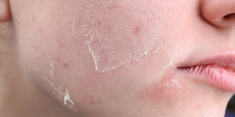 Dry vs Dehydrated Skin: Key Differences and How to Treat Both